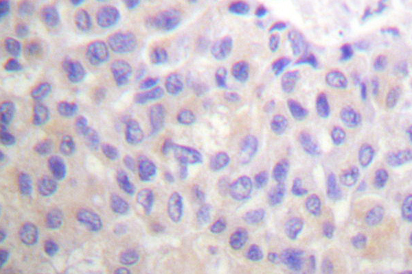 BCAR1 / p130Cas Antibody - IHC of p130 Cas (P160) pAb in paraffin-embedded human breast carcinoma tissue.