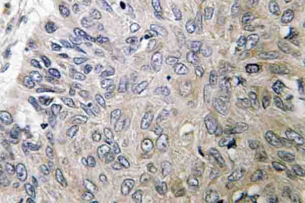 BCAR1 / p130Cas Antibody - IHC of p130 Cas (V404) pAb in paraffin-embedded human lung carcinoma tissue.