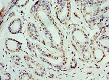 BCAS2 Antibody - Immunohistochemistry of paraffin-embedded human breast cancer using antibody at 1:100 dilution.