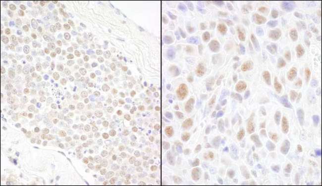 BCAS2 Antibody - Detection of Human and Mouse BCAS2 by Immunohistochemistry. Sample: FFPE section of human small cell lung cancer (left) and mouse squamous cell carcinoma (right). Antibody: Affinity purified rabbit anti-BCAS2 used at a dilution of 1:5000 (0.2 ug/ml).