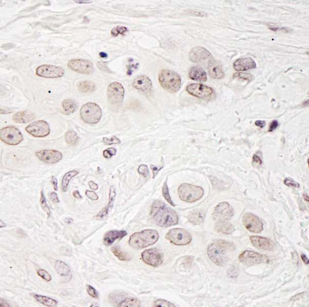 BCAS3 Antibody - Detection of Human BCAS3 by Immunohistochemistry. Sample: FFPE section of human breast carcinoma. Antibody: Affinity purified rabbit anti-BCAS3 used at a dilution of 1:200 (1 ug/ml).