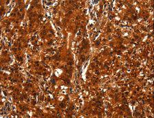BCAS3 Antibody - Immunohistochemistry of paraffin-embedded Human thyroid cancer using BCAS3 Polyclonal Antibody at dilution of 1:40.