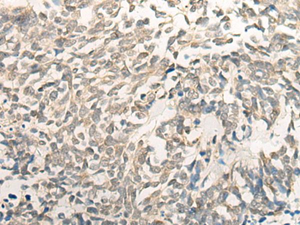 BCAS3 Antibody - Immunohistochemistry of paraffin-embedded Human lung cancer tissue  using BCAS3 Polyclonal Antibody at dilution of 1:35(×200)