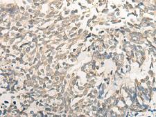 BCAS3 Antibody - Immunohistochemistry of paraffin-embedded Human lung cancer tissue  using BCAS3 Polyclonal Antibody at dilution of 1:35(×200)