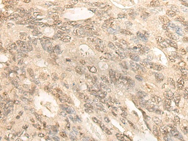 BCAS3 Antibody - Immunohistochemistry of paraffin-embedded Human colorectal cancer tissue  using BCAS3 Polyclonal Antibody at dilution of 1:35(×200)