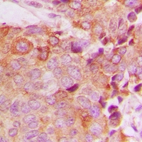 BCAS4 Antibody - Immunohistochemical analysis of BCAS4 staining in human breast cancer formalin fixed paraffin embedded tissue section. The section was pre-treated using heat mediated antigen retrieval with sodium citrate buffer (pH 6.0). The section was then incubated with the antibody at room temperature and detected with HRP and DAB as chromogen. The section was then counterstained with hematoxylin and mounted with DPX.