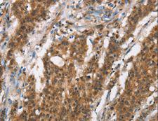 BCAS4 Antibody - Immunohistochemistry of paraffin-embedded Human gastric cancer using BCAS4 Polyclonal Antibody at dilution of 1:50.