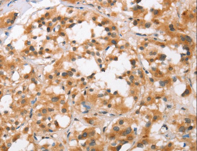 BCAS4 Antibody - Immunohistochemistry of paraffin-embedded Human thyroid cancer using BCAS4 Polyclonal Antibody at dilution of 1:50.