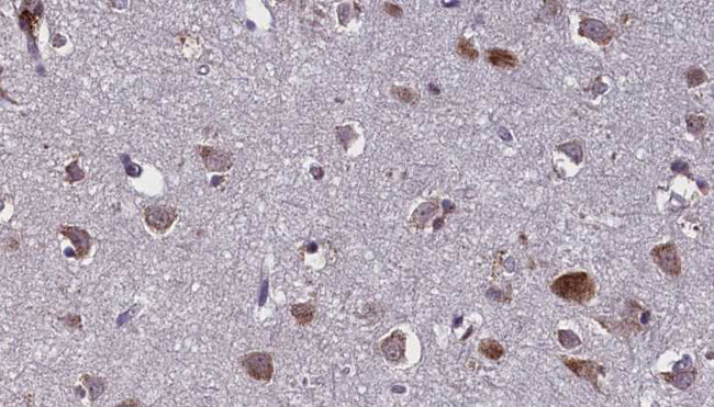 BCAS4 Antibody - 1:100 staining human brain carcinoma tissue by IHC-P. The sample was formaldehyde fixed and a heat mediated antigen retrieval step in citrate buffer was performed. The sample was then blocked and incubated with the antibody for 1.5 hours at 22°C. An HRP conjugated goat anti-rabbit antibody was used as the secondary.