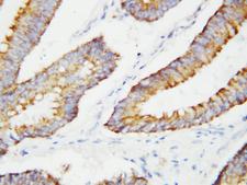 BCAT2 Antibody - BCAT2 antibody. IHC(P): Human Colon Cancer Tissue.