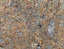 BCAT2 Antibody - Immunohistochemistry of paraffin-embedded Human cervical cancer using BCAT2 Polyclonal Antibody at dilution of 1:70.