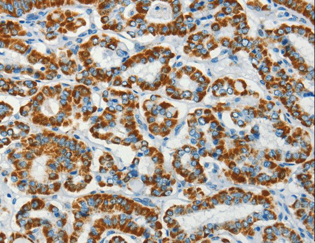 BCAT2 Antibody - Immunohistochemistry of paraffin-embedded Human thyroid cancer using BCAT2 Polyclonal Antibody at dilution of 1:70.