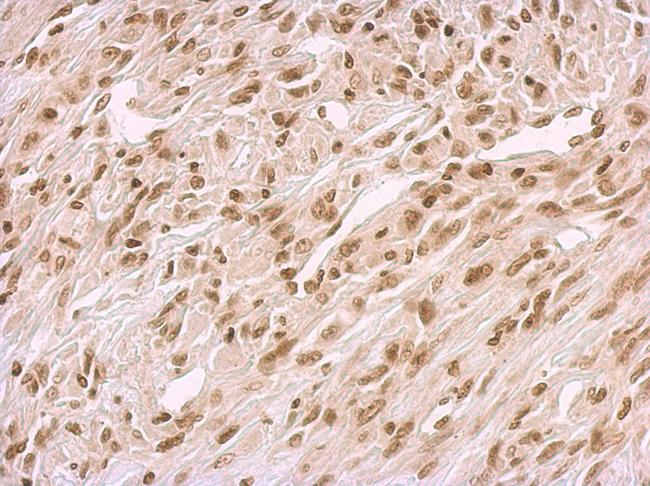 BCCIP Antibody - BCCIP antibody detects BCCIP protein at nucleus on U373 xenograft by immunohistochemical analysis. Sample: Paraffin-embedded U373 xenograft. BCCIP antibody dilution:1:500.