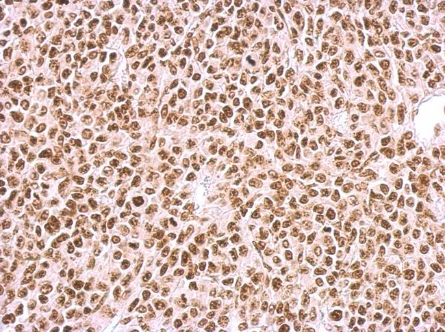 BCCIP Antibody - BCCIP antibody detects BCCIP protein at nucleus on BT483 xenograft by immunohistochemical analysis. Sample: Paraffin-embedded BT483 xenograft. BCCIP antibody dilution:1:500.