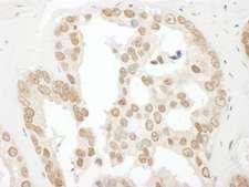 BCCIP Antibody - Detection of Human BCCIP by Immunohistochemistry. Sample: FFPE section of human prostate carcinoma. Antibody: Affinity purified rabbit anti-BCCIP used at a dilution of 1:1000 (1 ug/ml).