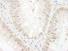 BCCIP Antibody - Detection of Human BCCIP by Immunohistochemistry. Sample: FFPE section of human colon carcinoma. Antibody: Affinity purified rabbit anti-BCCIP used at a dilution of 1:250.