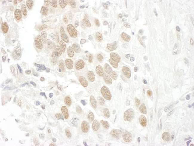 BCCIP Antibody - Detection of Human BCCIP by Immunohistochemistry. Sample: FFPE section of human testicular seminoma. Antibody: Affinity purified rabbit anti-BCCIP used at a dilution of 1:250.