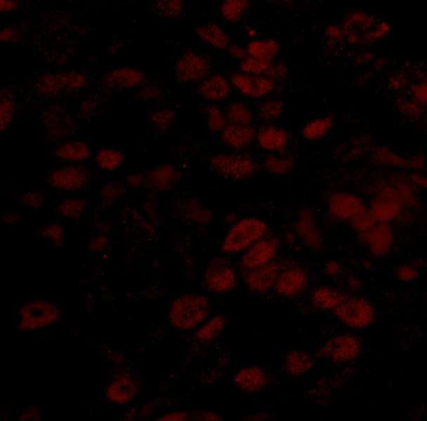 BCCIP Antibody - Detection of Human BCCIP by Immunohistochemistry. Sample: FFPE section of human breast carcinoma. Antibody: Affinity purified rabbit anti-BCCIP used at a dilution of 1:100. Detection: Red-fluorescent Goat anti-Rabbit IgG-heavy and light chain cross-adsorbed Antibody DyLight 594 Conjugated (A120-601D4) used at a dilution of 1:100.