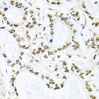 BCCIP Antibody - Immunohistochemistry of paraffin-embedded human gastric cancer tissue.