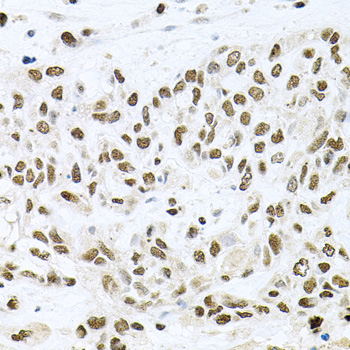 BCCIP Antibody - Immunohistochemistry of paraffin-embedded human lung cancer tissue.