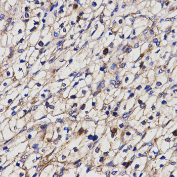 BCHE / Cholinesterase Antibody - Immunohistochemistry of paraffin-embedded human kidney cancer using BCHE antibody at dilution of 1:200 (x400 lens).