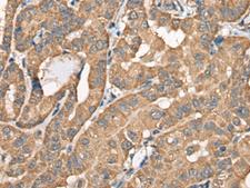 BCHE / Cholinesterase Antibody - Immunohistochemistry of paraffin-embedded Human thyroid cancer tissue  using BCHE Polyclonal Antibody at dilution of 1:40(×200)