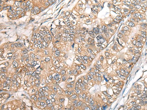 BCHE / Cholinesterase Antibody - Immunohistochemistry of paraffin-embedded Human gastric cancer tissue  using BCHE Polyclonal Antibody at dilution of 1:40(×200)