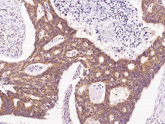 BCKDHA / BCKDE1A Antibody - Immunochemical staining of human BCKDHA in human colon carcinoma with rabbit polyclonal antibody at 1:200 dilution, formalin-fixed paraffin embedded sections.