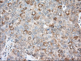 BCL10 / BCL-10 Antibody - Immunohistochemical staining of paraffin-embedded Adenocarcinoma of Human ovary tissue using anti-BCL10 mouse monoclonal antibody. (Dilution 1:50).