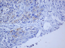 BCL10 / BCL-10 Antibody - IHC of paraffin-embedded Carcinoma of Human lung tissue using anti-BCL10 mouse monoclonal antibody.