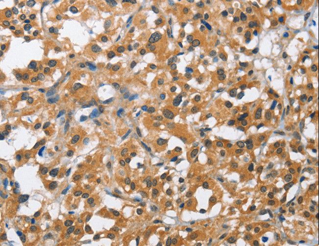 BCL10 / BCL-10 Antibody - Immunohistochemistry of paraffin-embedded Human thyroid cancer using BCL10 Polyclonal Antibody at dilution of 1:40.
