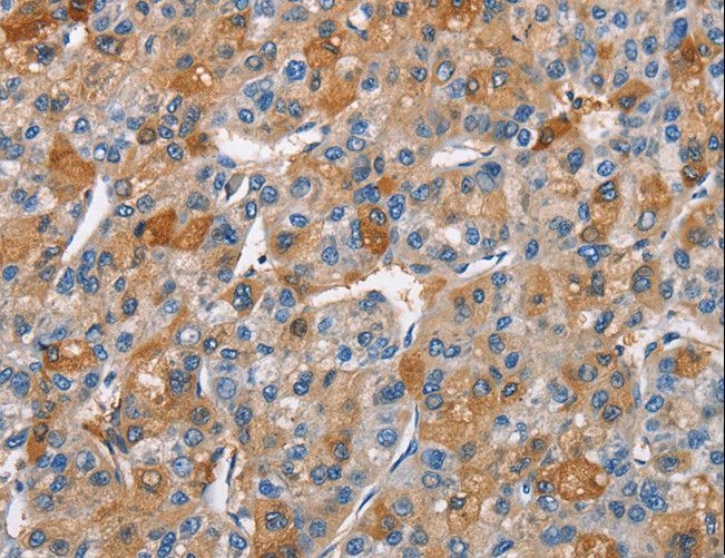 BCL10 / BCL-10 Antibody - Immunohistochemistry of paraffin-embedded Human liver cancer using BCL10 Polyclonal Antibody at dilution of 1:40.