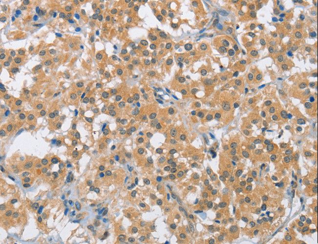 BCL10 / BCL-10 Antibody - Immunohistochemistry of paraffin-embedded Human thyroid cancer using BCL10 Polyclonal Antibody at dilution of 1:40.