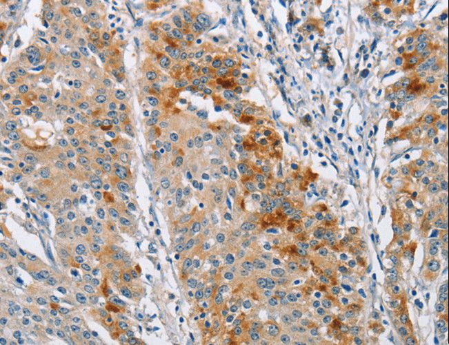BCL10 / BCL-10 Antibody - Immunohistochemistry of paraffin-embedded Human gastric cancer using BCL10 Polyclonal Antibody at dilution of 1:40.