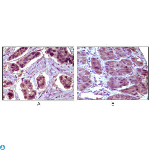 BCL10 / BCL-10 Antibody - Immunohistochemistry (IHC) analysis of paraffin-embedded Human Breast Carcinoma (A) and liver carcinoma (B), showing cytoplasmic localization with DAB staining using Bcl-10 Monoclonal Antibody.