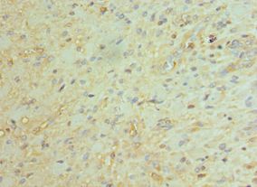 BCL11A Antibody - Immunohistochemistry of paraffin-embedded human glioma using antibody at 1:100 dilution.