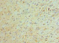 BCL11A Antibody - Immunohistochemistry of paraffin-embedded human glioma using antibody at 1:100 dilution.