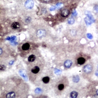 BCL11A Antibody - Immunohistochemical analysis of BCL11A staining in human liver cancer formalin fixed paraffin embedded tissue section. The section was pre-treated using heat mediated antigen retrieval with sodium citrate buffer (pH 6.0). The section was then incubated with the antibody at room temperature and detected using an HRP conjugated compact polymer system. DAB was used as the chromogen. The section was then counterstained with hematoxylin and mounted with DPX.