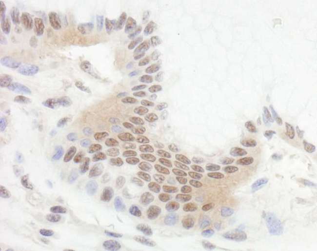 BCL11B Antibody - Detection of Human Bcl11b by Immunohistochemistry. Sample: FFPE section of human stomach carcinoma. Antibody: Affinity purified rabbit anti-Bcl11b used at a dilution of 1:1000 (1 ug/ml).