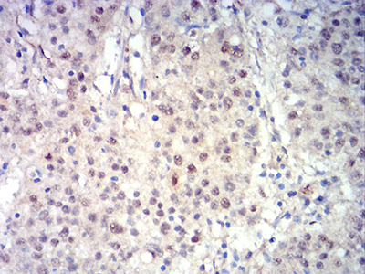 BCL11B Antibody - Immunohistochemical analysis of paraffin-embedded stomach cancer tissues using BCL11B mouse mAb with DAB staining.