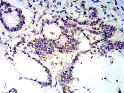 BCL11B Antibody - Immunohistochemical analysis of paraffin-embedded colon cancer tissues using BCL11B mouse mAb with DAB staining.