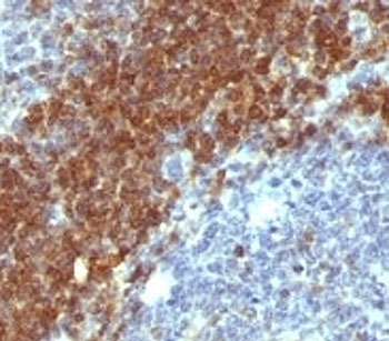 BCL2 / Bcl-2 Antibody - Formalin-fixed, paraffin-embedded human non-Hodgkin's lymphoma stained with anti-Bcl-2 antibody (SPM530).  This image was taken for the unmodified form of this product. Other forms have not been tested.