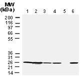 BCL2 / Bcl-2 Antibody - Western blot of Bcl-2 using Polyclonal Antibody to Bcl-2 at 1:2000.20 ug/protein was loaded per lane. Lane 1. Human Jurkat T cells. Lane 2. Human RS11 lymphoma cells. Lanes 3-6. Human breast cancer cases. Patient sample in lane 5 lacked detectible Bcl-2 expression.
