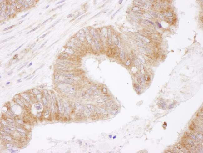 BCL2 / Bcl-2 Antibody - Detection of Human Bcl-2 by Immunohistochemistry. Sample: FFPE section of human colon carcinoma. Antibody: Affinity purified rabbit anti-Bcl-2 used at a dilution of 1:1000 (1 ug/ml). Detection: DAB.