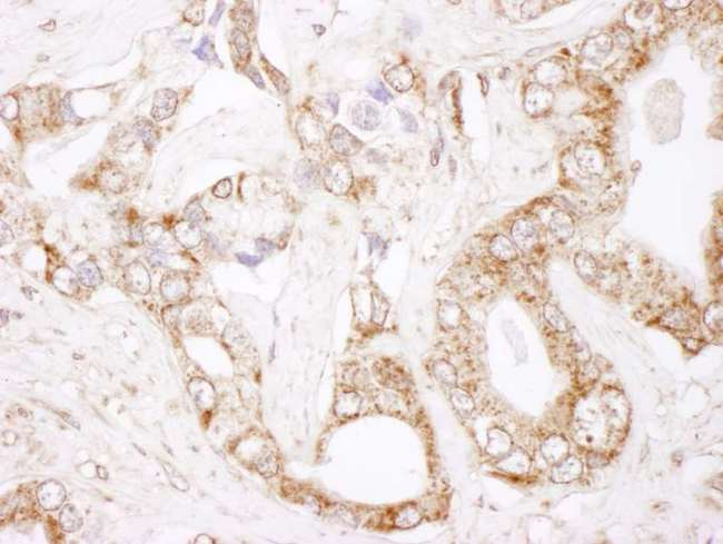 BCL2 / Bcl-2 Antibody - Detection of Human Bcl-2 by Immunohistochemistry. Sample: FFPE section of human prostate carcinoma. Antibody: Affinity purified rabbit anti-Bcl-2 used at a dilution of 1:1000 (1 ug/ml). Detection: DAB.