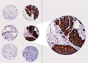 BCL2 / Bcl-2 Antibody - Formalin-fixed paraffin-embedded section of a human prostate cancer tissue array stained for Bcl-2 expression using Polyclonal Antibody to Bcl-2 at 1:2000. Hematoxylin-Eosin counterstain.