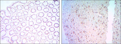 BCL2 / Bcl-2 Antibody - IHC of paraffin-embedded colon cancer tissues (left) and human brain tissues (right) using BCL-2 mouse monoclonal antibody with DAB staining.