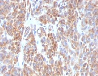 BCL2 / Bcl-2 Antibody - IHC testing of FFPE human melanoma with Bcl2 antibody (clone ARBC2-1).  This image was taken for the unmodified form of this product. Other forms have not been tested.