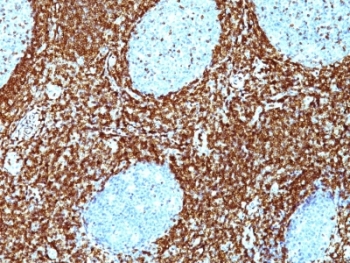 BCL2 / Bcl-2 Antibody - Formalin-fixed, paraffin-embedded human non-Hodgkin's lymphoma stained with Bcl-2 antibody (BCL2/782 + BCL2/796).  This image was taken for the unmodified form of this product. Other forms have not been tested.