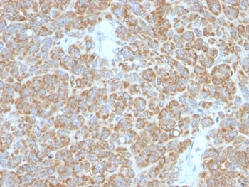 BCL2 / Bcl-2 Antibody - Formalin-fixed, paraffin-embedded human melanoma stained with Bcl-2 antibody.  This image was taken for the unmodified form of this product. Other forms have not been tested.